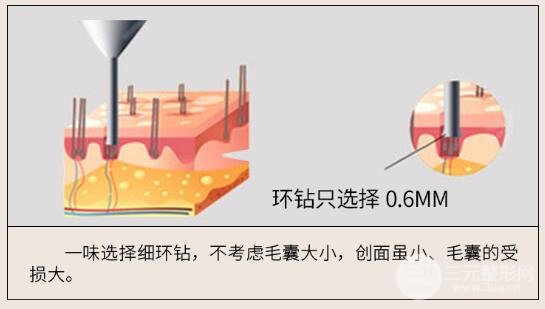 什么是毛发种植?