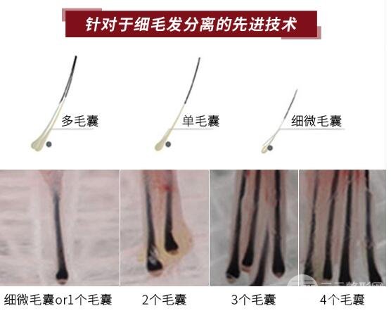 毛发种植新技术:微针植发