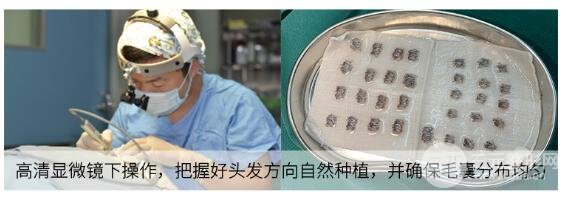 毛发种植新技术:微针植发