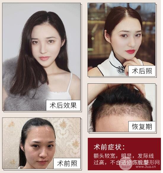 毛发种植前的注意事项
