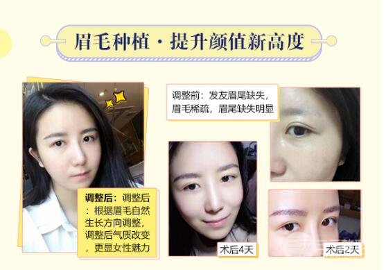 种植眉毛后的注意事项