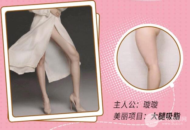 大腿抽脂前的注意事项