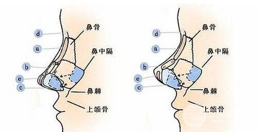 什么是鼻头缩小手术?