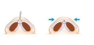 什么是鼻头缩小手术?