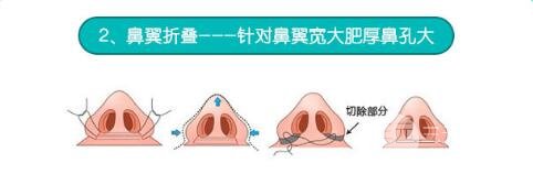 鼻头缩小多少钱?
