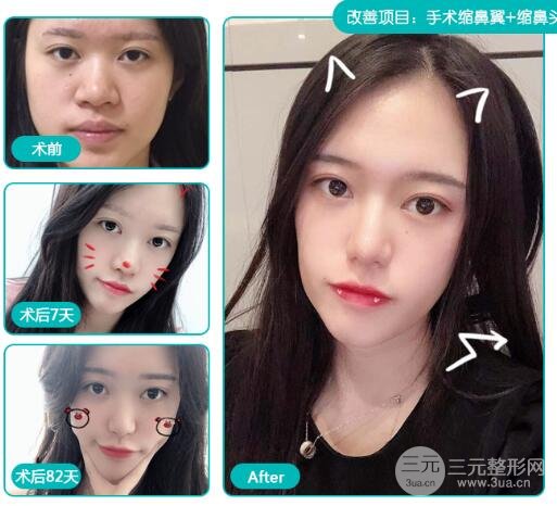 鼻头缩小多少钱?