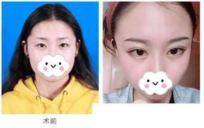 北京协和整形医院割双眼皮技术如何？费用贵不贵？