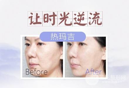 #术前了解#热玛吉除皱能维持多久?果好不好呢?