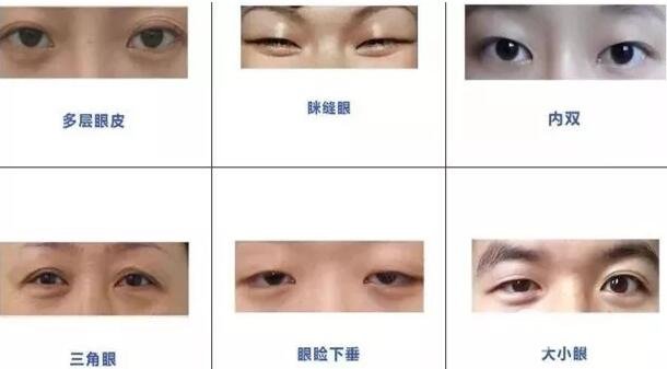 #超全解答#做双眼皮一般多少钱？关键是……