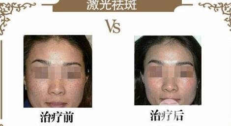 祛斑的方法