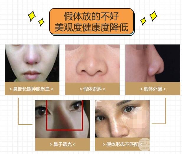 隆鼻失败的解决方法