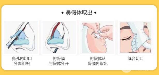 隆鼻后这5种情况要警惕