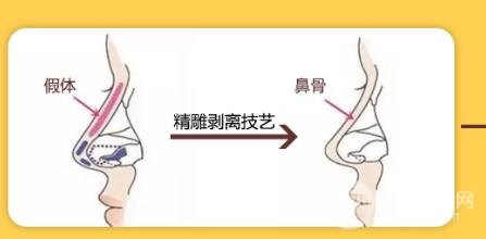 隆鼻后这5种情况要警惕