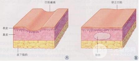 注射瘦脸/除皱去皱的原理