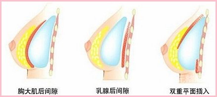 #术前了解#假体隆胸手感和真的有没有区别吗?