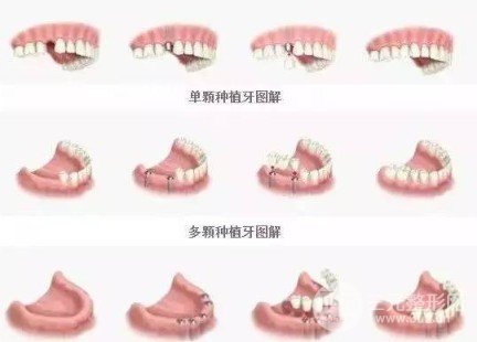 广东省口腔医院种植牙经历分享