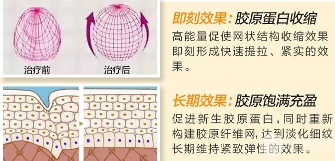 热玛吉第三代的果不好?看了图片可能会打脸!