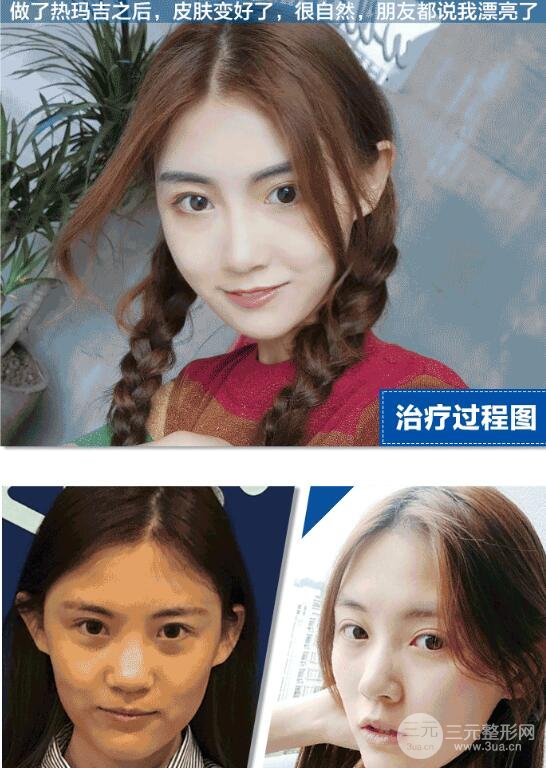 热玛吉第三代的果不好?看了图片可能会打脸!