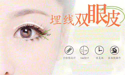 #术前功课#北京双眼皮整形多少钱？
