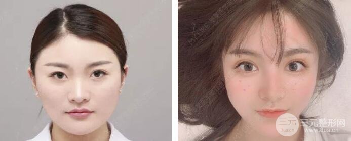 #术前功课#北京双眼皮整形多少钱？