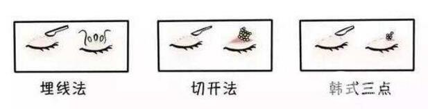 #术前功课#北京双眼皮整形多少钱？