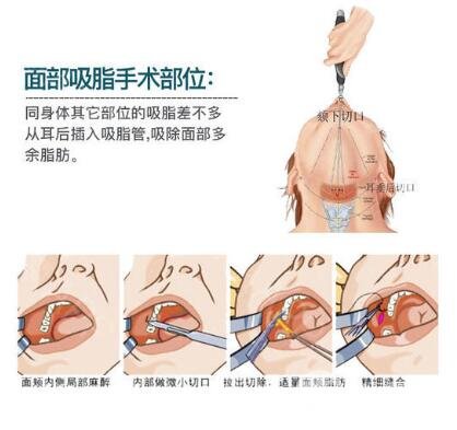 光纤溶脂瘦脸是长时间的吗?