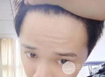 西京医院植发价目表2020