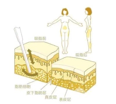 瘦小腿抽脂好还是注射瘦腿好？2种方法大PK！