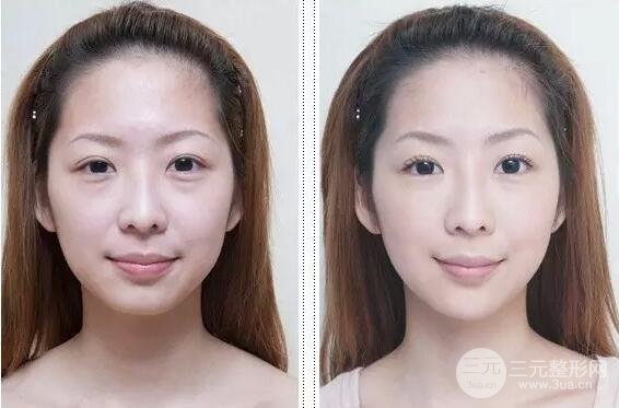 眼袋失败修复方法如下，送给爱美的你！