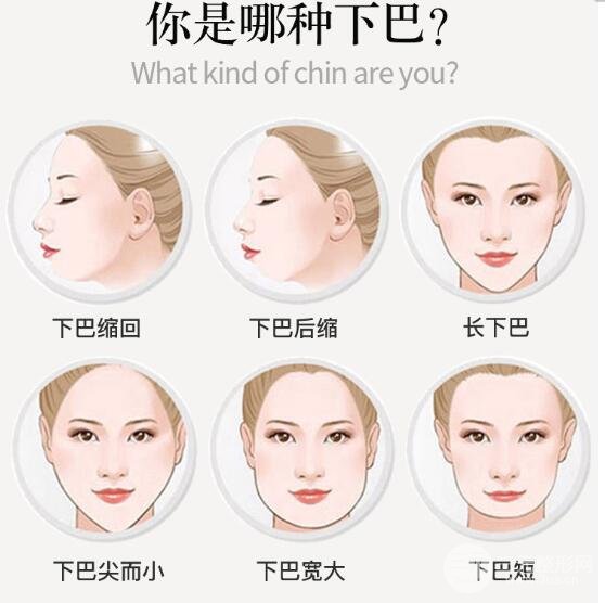 假体垫下巴适应人群