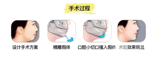 假体垫下巴注意事项