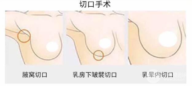 注射法隆胸优点