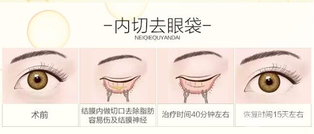 内切去眼袋多久恢复期?