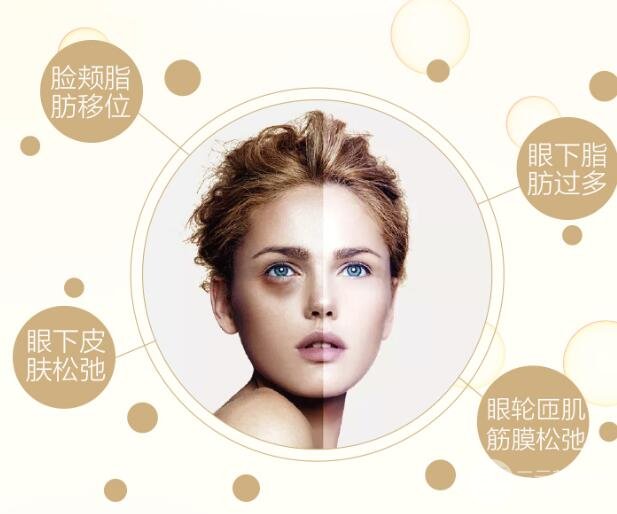 内切去眼袋多久恢复期?