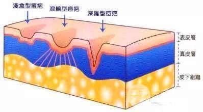 像素激光祛痘的果：这种祛痘方法你居然还不知道~
