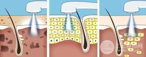 像素激光祛痘的果：这种祛痘方法你居然还不知道~