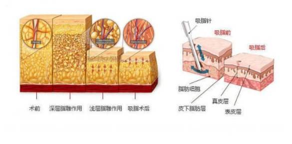 吸脂瘦大腿肿胀期是多久？做好术后护理可以缩短时间~