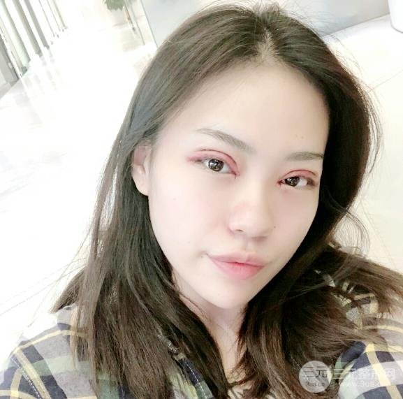分享！湘雅三医院整形科双眼皮手术案例，附全新价格表~