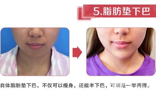 隆下巴的价格差异这么大？！快来看看避坑指南！