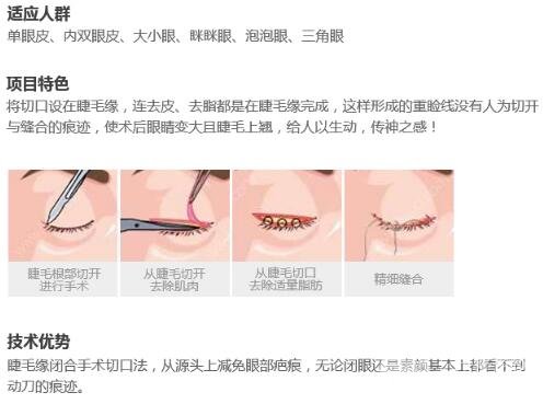 微创全切双眼皮的原理?