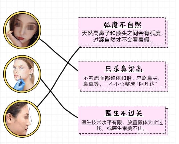 假体隆鼻优势有哪些?