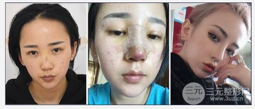 隆鼻假体取出后恢复时间