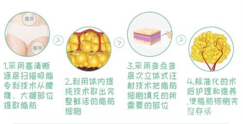 自体脂肪填充苹果肌优势