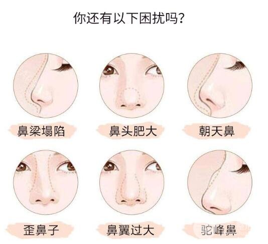 鼻翼缩小修复手术优势