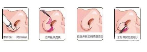 鼻翼缩小修复手术注意事项