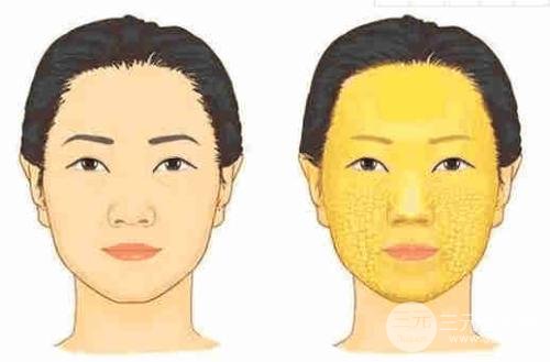 脸部自体脂肪填充价格多少？受到几点因素影响哦~