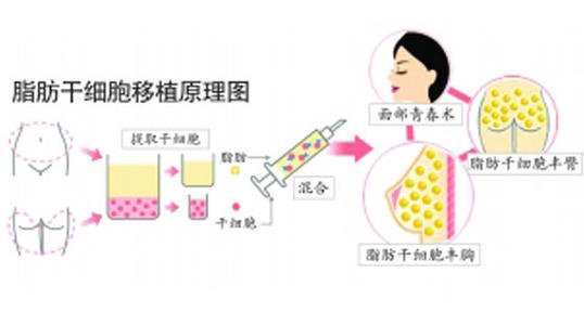 脸部自体脂肪填充价格多少？受到几点因素影响哦~