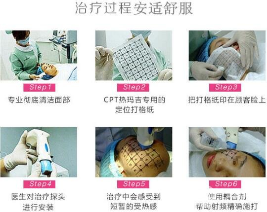热玛吉紧肤大概多少钱