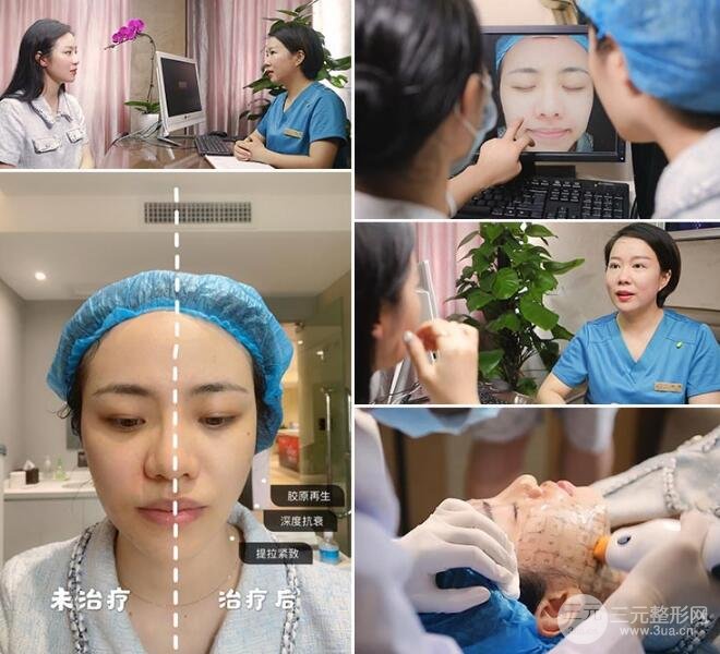 热玛吉紧肤果图