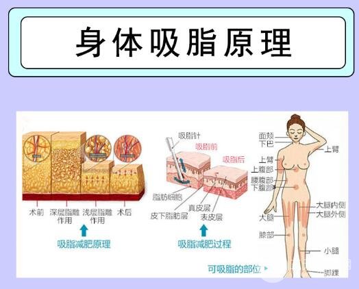 腹部吸脂手术后的注意事项